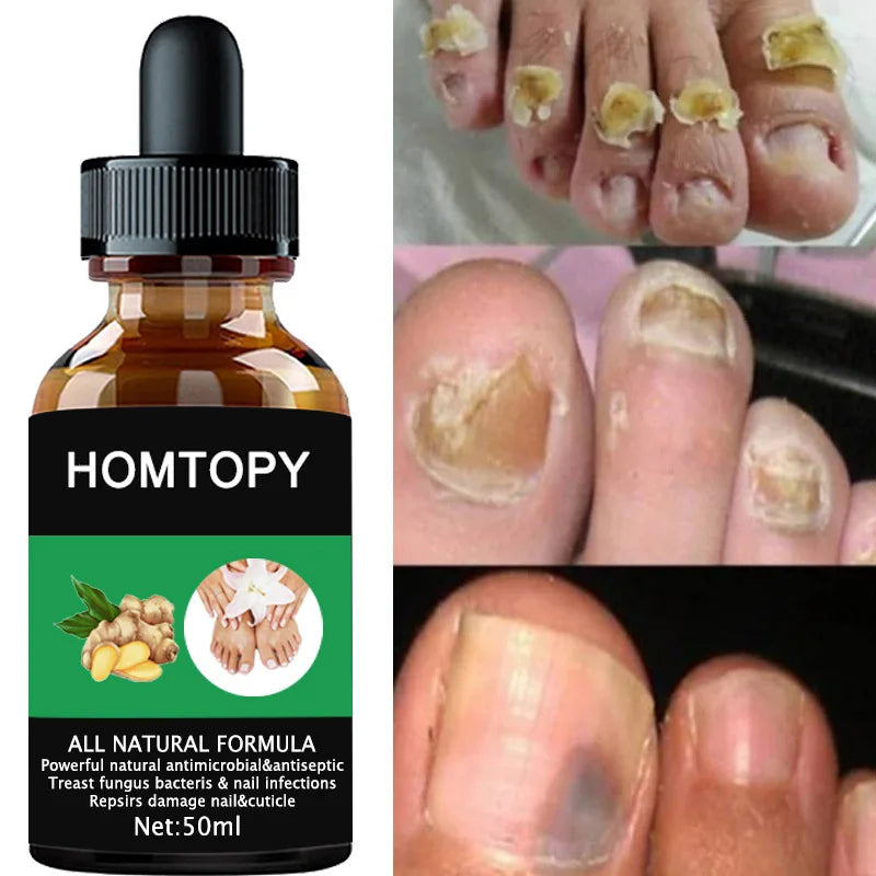 7 Days Nail Fungal Treatment Serum Oil Foot Toe Nail Fungus Removal Serum Repair Onychomycosi Anti Infection Uñas Care Products