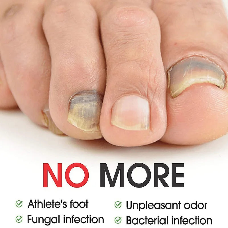 7 Days Nail Fungal Treatment Serum Oil Foot Toe Nail Fungus Removal Serum Repair Onychomycosi Anti Infection Uñas Care Products