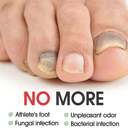 7 Days Nail Fungal Treatment Serum Oil Foot Toe Nail Fungus Removal Serum Repair Onychomycosi Anti Infection Uñas Care Products