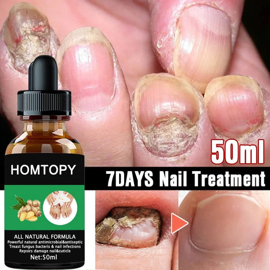 7 Days Nail Fungal Treatment Serum Oil Foot Toe Nail Fungus Removal Serum Repair Onychomycosi Anti Infection Uñas Care Products