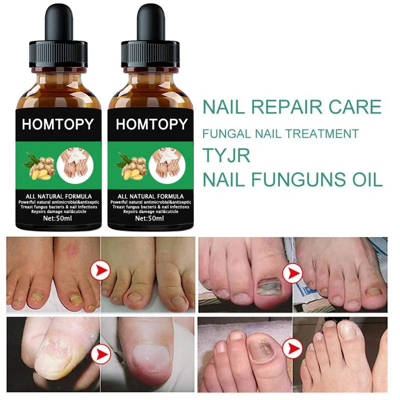7 Days Nail Fungal Treatment Serum Oil Foot Toe Nail Fungus Removal Serum Repair Onychomycosi Anti Infection Uñas Care Products
