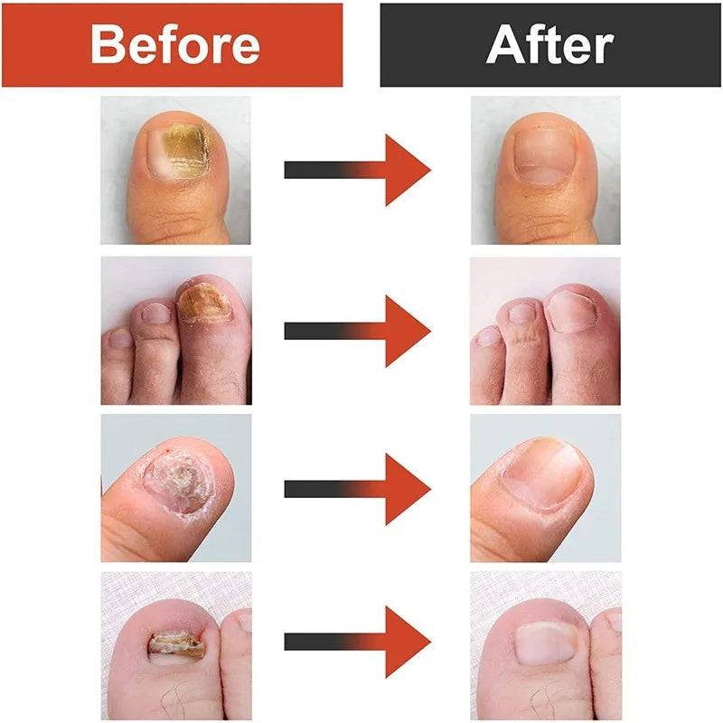 7 Days Nail Fungal Treatment Serum Oil Foot Toe Nail Fungus Removal Serum Repair Onychomycosi Anti Infection Uñas Care Products